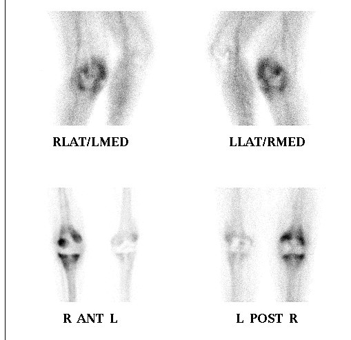 Revision TKR Infected Bone Scan